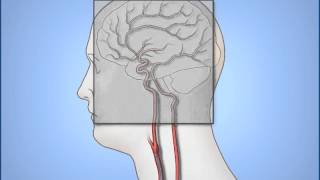 Intracranial Bleed  Part 1 [upl. by Haughay]