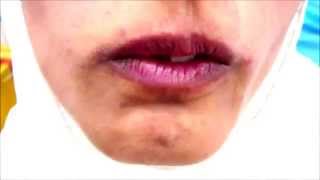 Orofacial Dyskinesia [upl. by Matless]