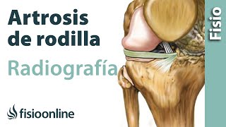 Artrosis de rodilla  Qué es y cómo se diagnostica en radiografías [upl. by Stich238]