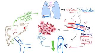 Hepatopulmonary syndrome [upl. by Thecla]