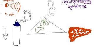 The Acute Complications of Cirrhosis  An Overview [upl. by Odnumyer358]